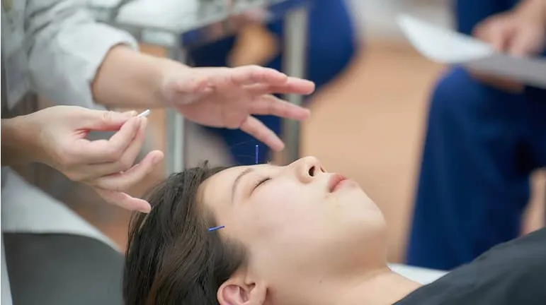 顔に鍼を打たれている女性